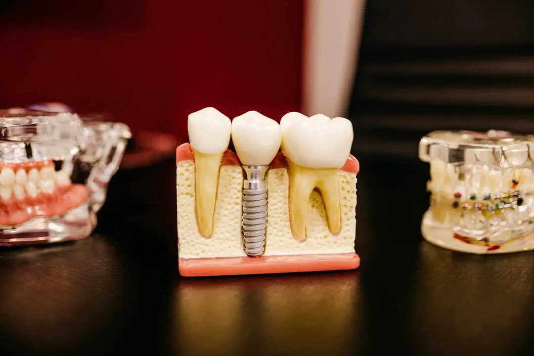 cost of full mouth dental implants